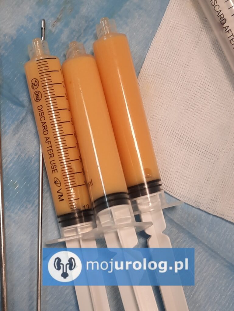 operacja zwiększona penisa przed i po)
